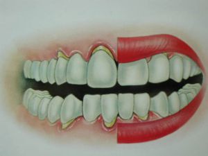 牙龈萎缩最好的治疗方法