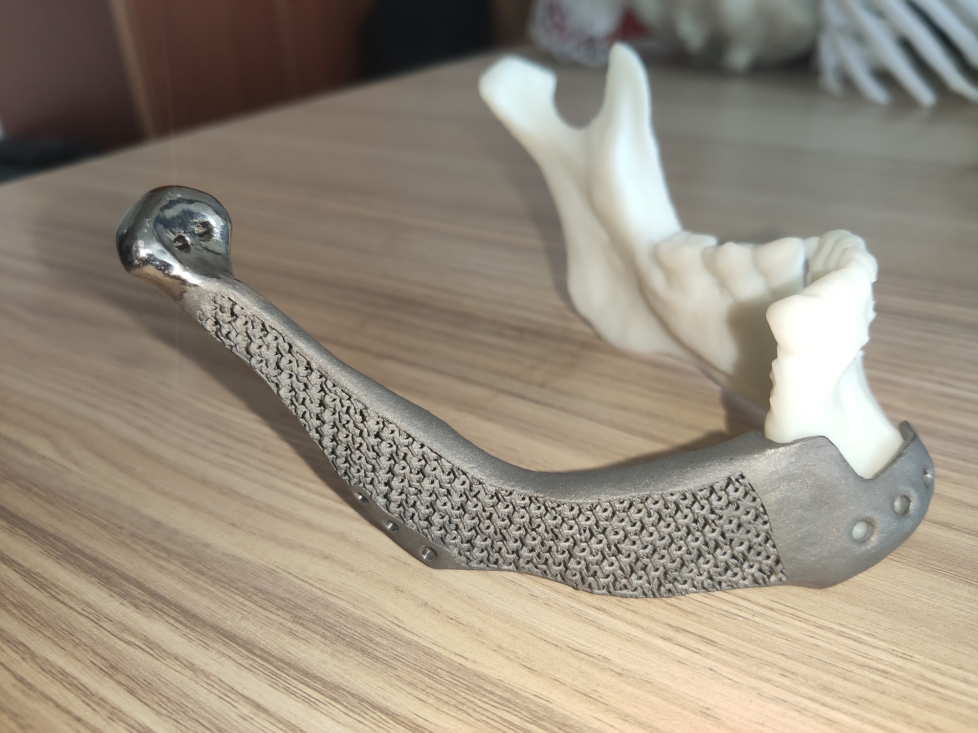 3D打印个性化钛合金骨修复假体的前驱探索与临床应用
